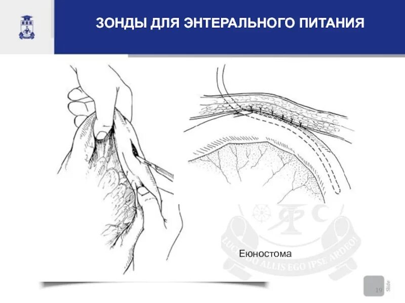Еюностома это. Еюностома техника операции.