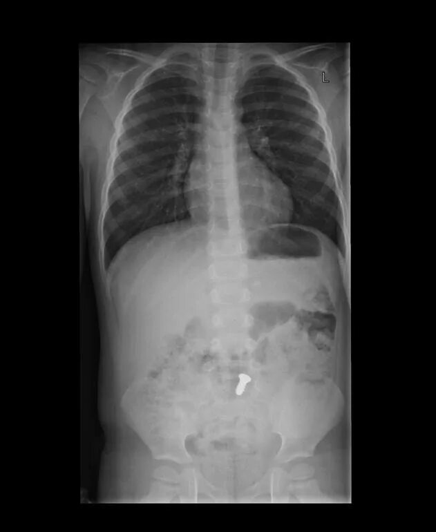 Монета в желудке рентген. Инородные тела у детей рентген. Проглоченная монета на рентгене. Ребенок проглотил монету 2 рубля. Девушки под рентгеном.