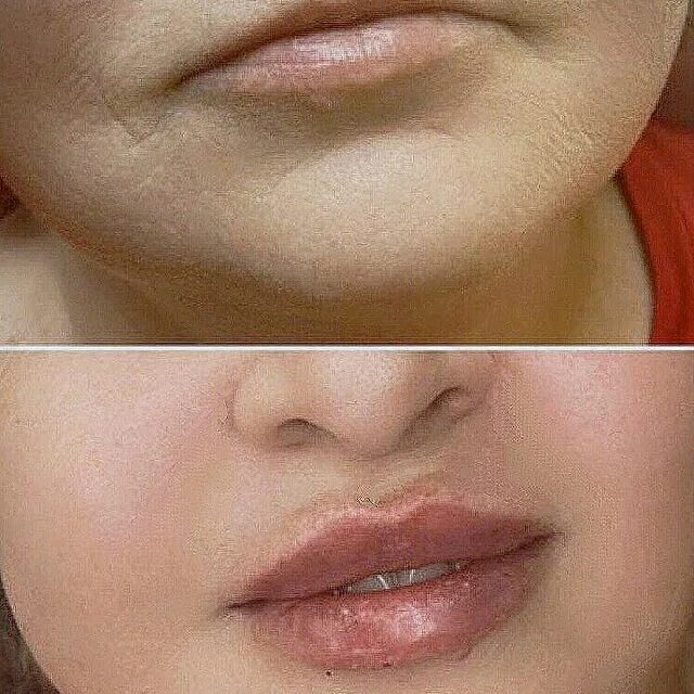 поднятие уголков губ ботоксом. гиалуроновая кислота для поднятия уголков губ. поднятие уголков губ гиалуроновой кислотой. приподнять уголки губ филлером. приподнятые уголки губ гиалуроновой кислотой.