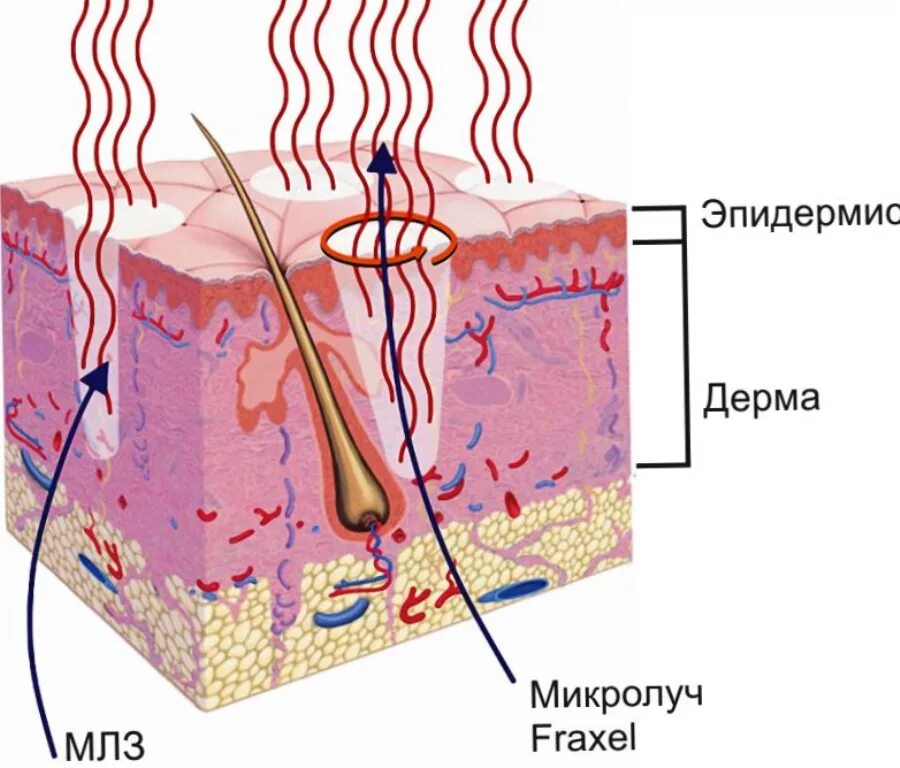 Лазерное воздействие на кожу skinlift ru. Фракционный лазер строение. Фракционный фототермолиз со2. Фракционное воздействие лазера. Селективный фототермолиз.