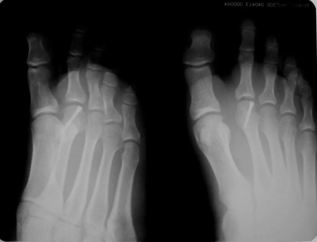 стрессовый перелом ладьевидной кости стопы. остеома плюсневой кости. перелом плюсневой кости стопы мкб 10. переломы костей костей стопы классификация. перелом плюсневой кости стопы мкб 10.