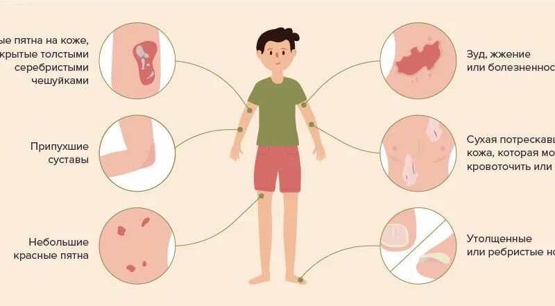 Как выглядит псориаз на коже у ребенка Epidermal Injury/Necrosis Plastic Surgery Key