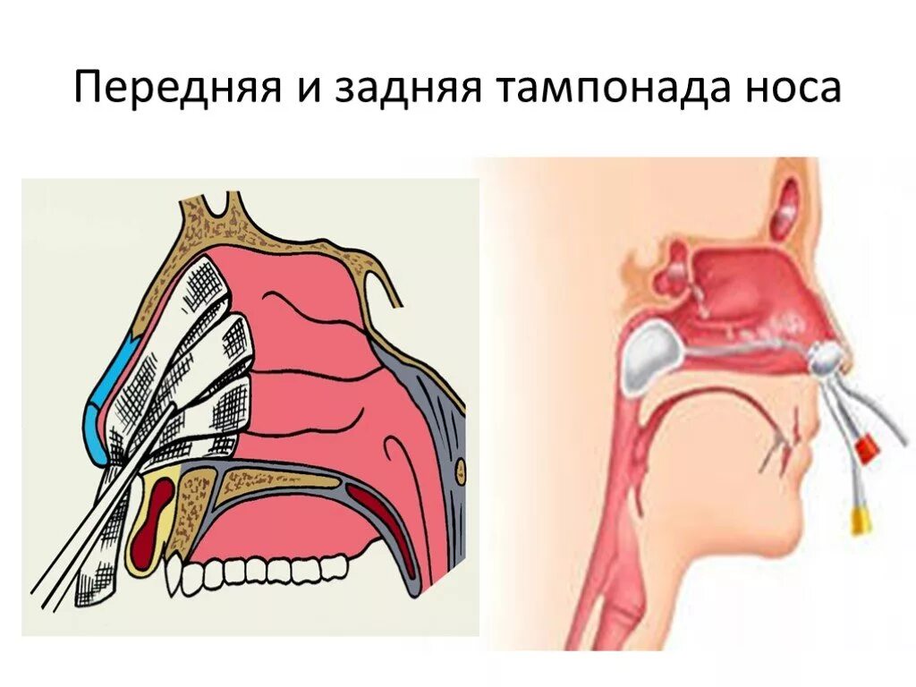 Задняя и передняя тампонада носового кровотечения. Удаление тампонады. Задняя и передняя тампонада носового кровотечения. Методика проведения передней тампонады носа. Передняя тампонада полости носа.