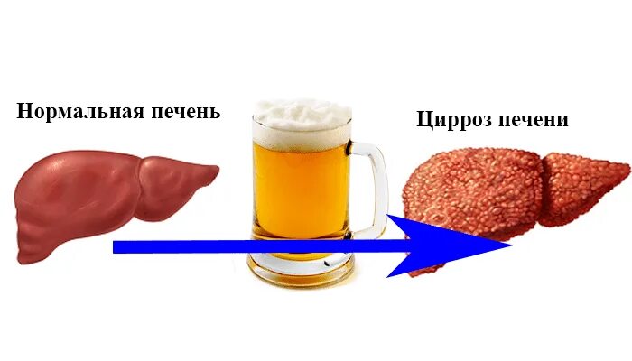 Страдает ли печень. Печень пивного алкоголика.