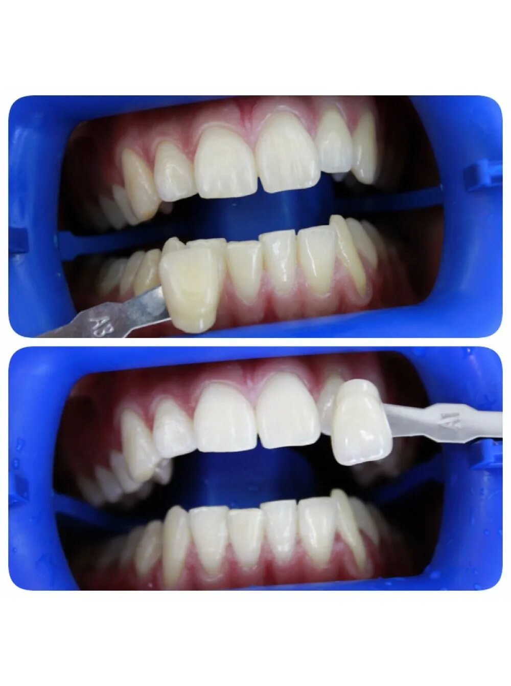 Лазерное отбеливание отзывы. Система отбеливания зубов клокс. Отбеливание инновационной системой Klox. Лазерное отбеливание зубов. Кабинетное отбеливание зубов.
