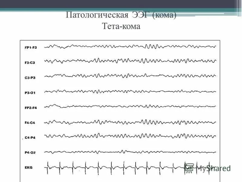 Легкие изменения ээг. Эпилептиформная активность на ЭЭГ. Пароксизмальная активность на ЭЭГ. Иктальный паттерн на ЭЭГ при эпилепсии. Судорожная активность на ЭЭГ.