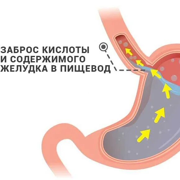 Рефлюкса купить. ГЭРБ клинические рекомендации.