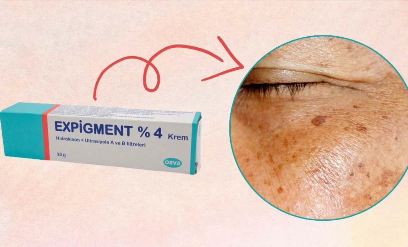Экспигмент. Крем expigment 4. мазь expigment. экспигмент крем турция. турецкий крем пигмент плюс.