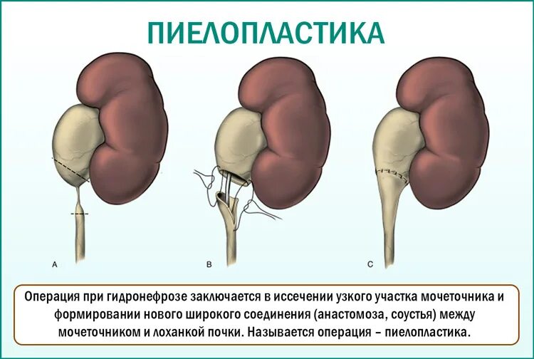 Пиелопластика по Хайнсу-Андерсену. Лапароскопическая пиелопластика. Диагноз гидронефроз почки. Операция почки гидронефроз пластика.