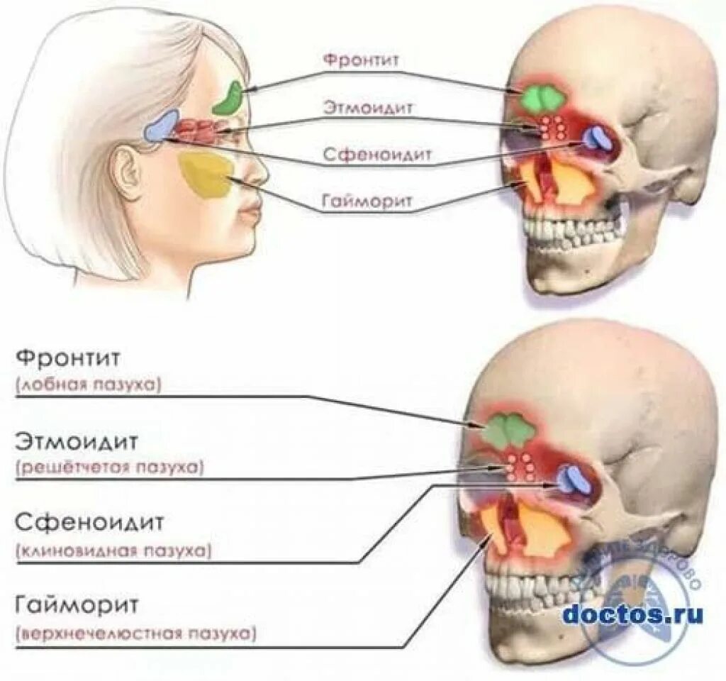 Хронический сфеноидит. Решетчатая кость этмоидит. Сфеноидит клинические симптомы. Воспаление основной пазухи сфеноидит.