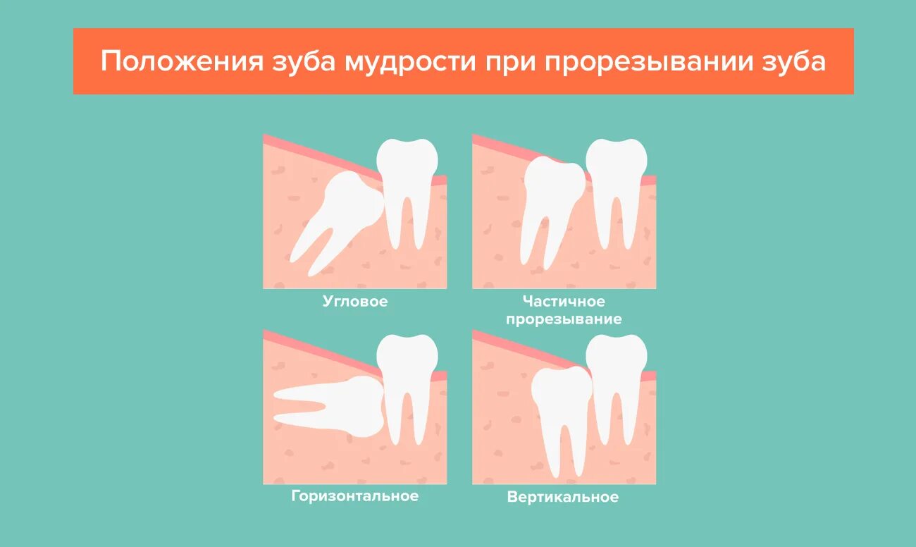 Зуб мудрости почему так назван. Положение зуба мудрости. Зуб мудрости проростается. Прорезывается зуб мудрости. Прорезывание зуба мудрости.