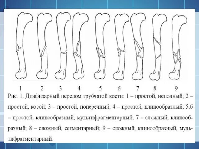 Классификация переломов по плоскости излома. Перелом малой берцовой кости классификация. Берцовая кость повреждения. Классификация переломов по направлению и форме.