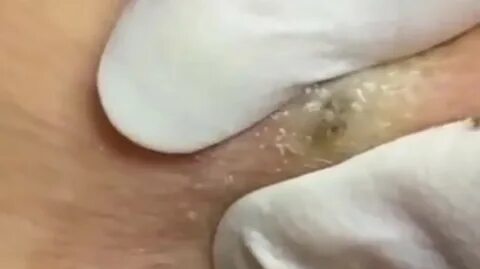 groot, puist, blackhead, ranzig, wtf, lichaam, pus.