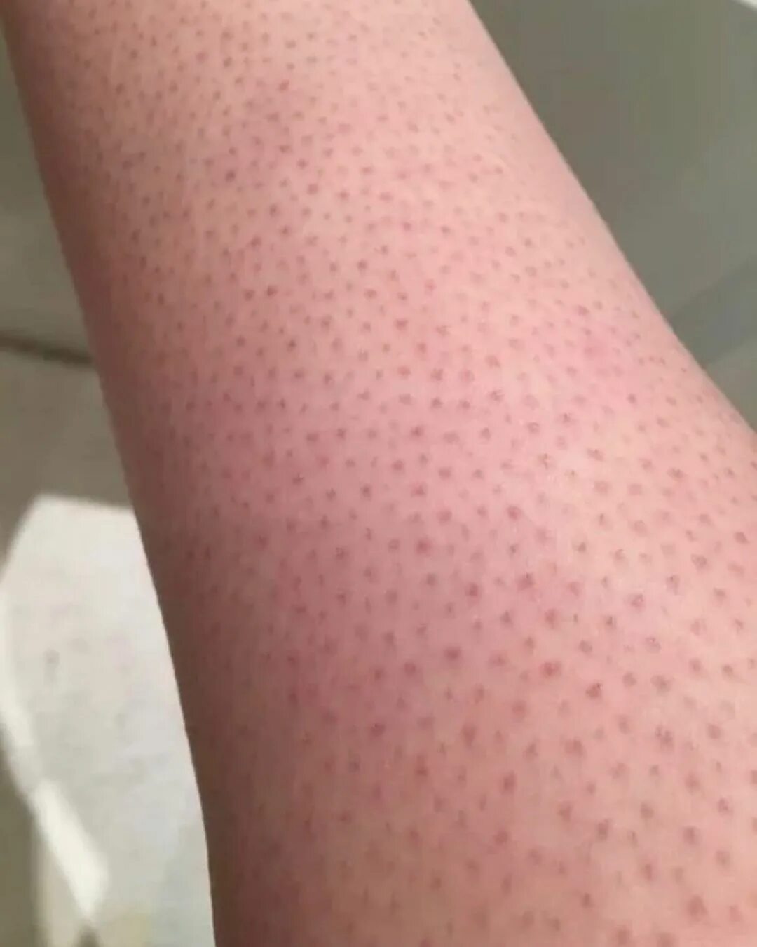 Гусиный. Фолликулярный гиперкератоз. Фолликулярный гиперкератоз красный. Сыпь как гусиная кожа у ребенка. Фолликулярный кератоз («гусиная.