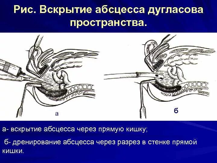 Пункция абсцесса дугласова пространства. Вскрытие и дренирование абсцесса. Пункция прямокишечно-маточного. Дугласово пространство дренирование. Операции через прямую кишку