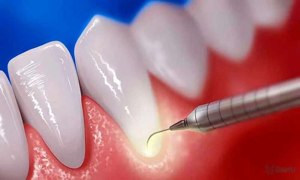 Лазерный кюретаж пародонтальных карманов. Зондирование пародонтальных карманов. Гингивэктомия пародонтит. Скейлинг пародонтальных карманов. Лечение десен домашними средствами