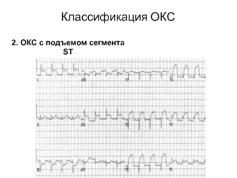 Экг подъем