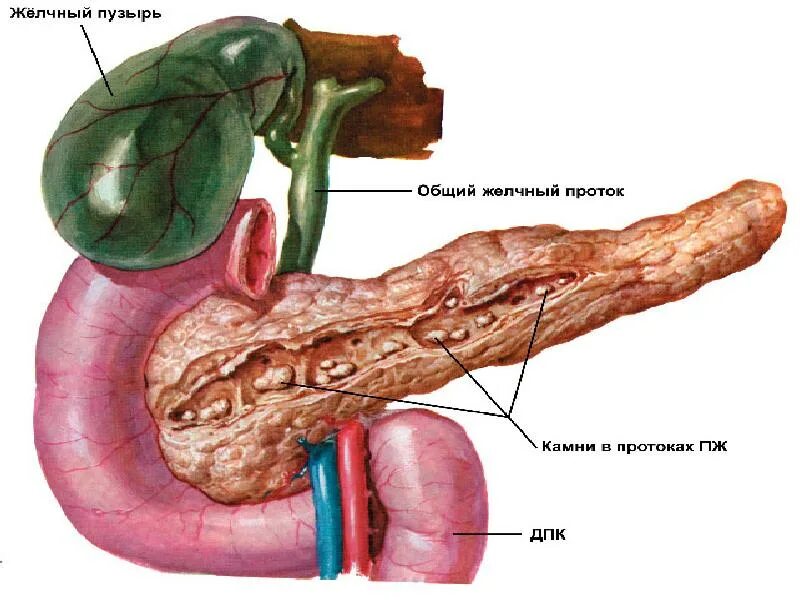 Хронический панкреатит поджелудочная железа. Хронический калькулезный панкреатит. Панкреатит камни в поджелудочной.