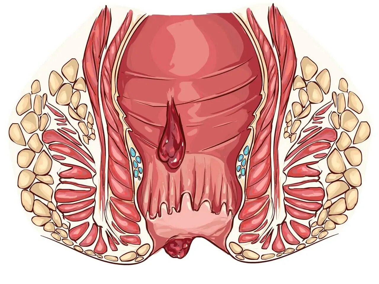 Наружный и внутренний геморрой. Боли внутри заднего прохода