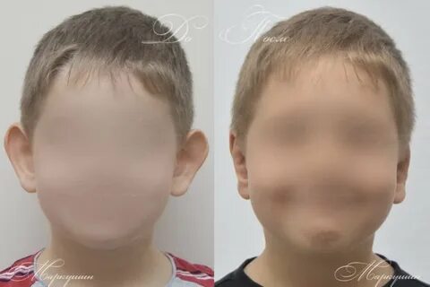 Исправить уши ребенку