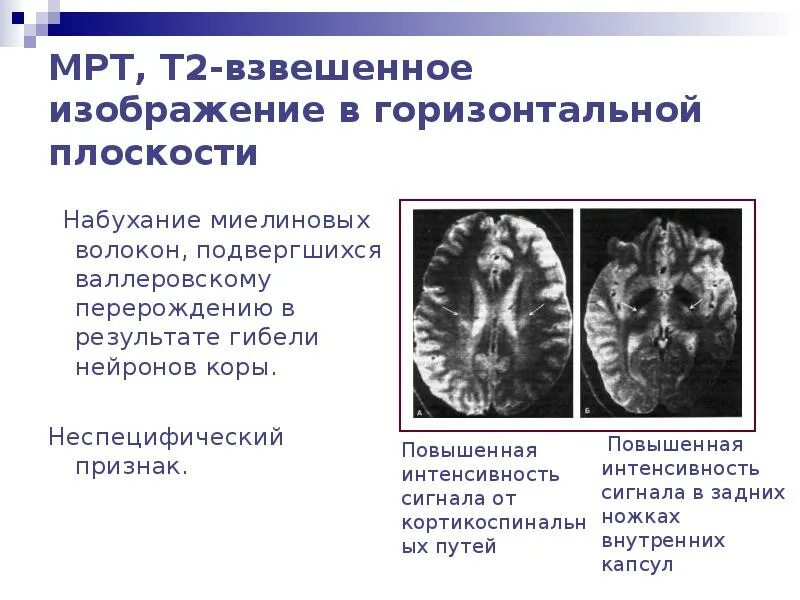 Дегенерация головного. Мрт при боковом амиотрофическом склерозе. Боковой амиотрофический склероз мрт. Валлеровская дегенерация. Валлеровская дегенерация мрт.