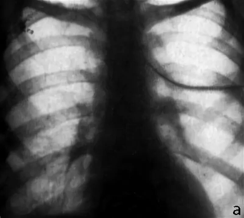 Буллезная болезнь легких рентген. Врожденная лобарная эмфизема. Удаление булл в легких. Удаление булл в легких. Буллёзная эмфизема лёгких рентген.