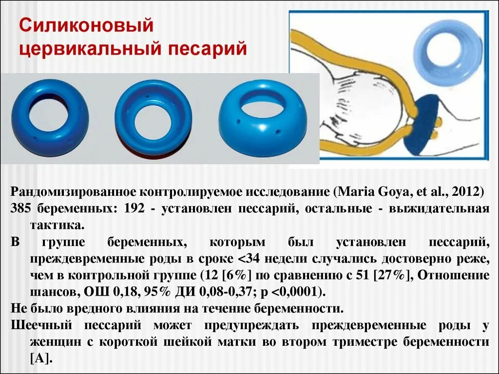 37 недель пессарий. ИЦН акушерский пессарий. Методика постановки акушерского пессария. Навэль пессарий акушерский. Акушерское кольцо пессарий.