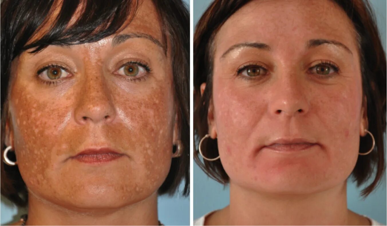 Когда ее лицо становилось лучше. Эрбиевый лазер м22. Пилинг ТСА (трихлоруксусной кислотой). Пигментация на лице до и после.