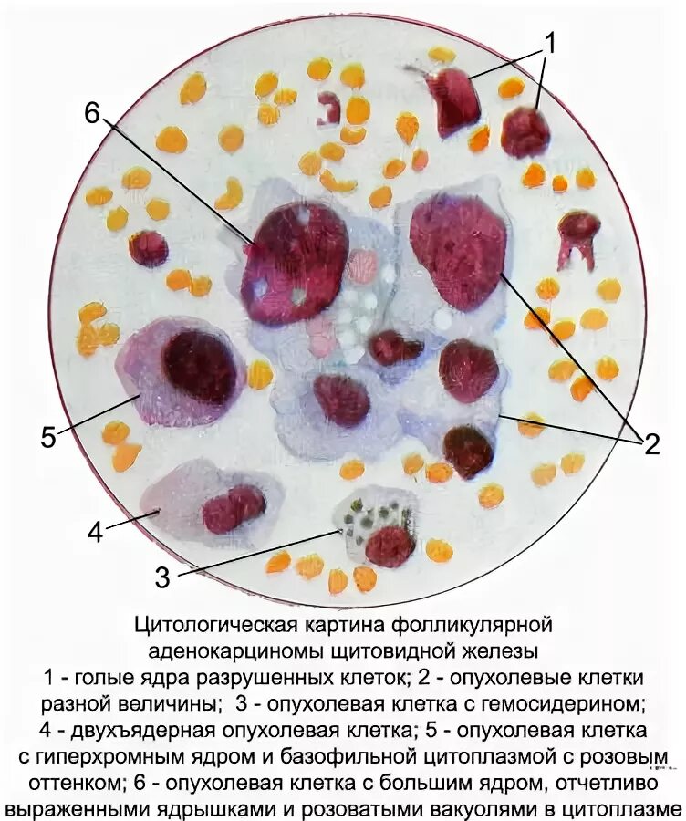 Цитологическое исследование пунктата. Цитология опухоли щитовидной железы. Фолликулярная опухоль цитология. Клетки щитовидной железы цитология. Фолликулярная карцинома гистология.