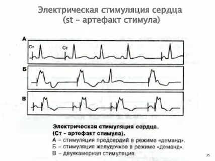 Сердечная стимуляция