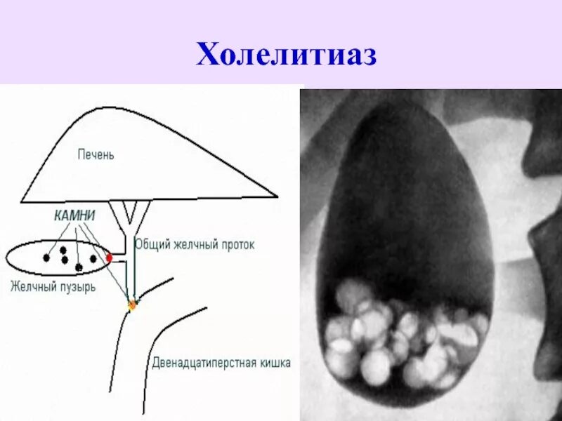 Камушек желчный пузырь