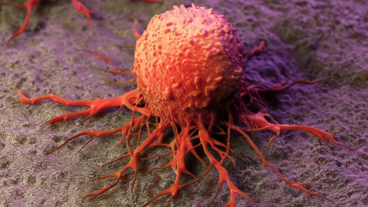Злокачественная опухоль. Раковые клетки под микроскопом. Раковые клетки микроскоп. Раковая клетка подтмикроскопом. Онкология под микроскопом.