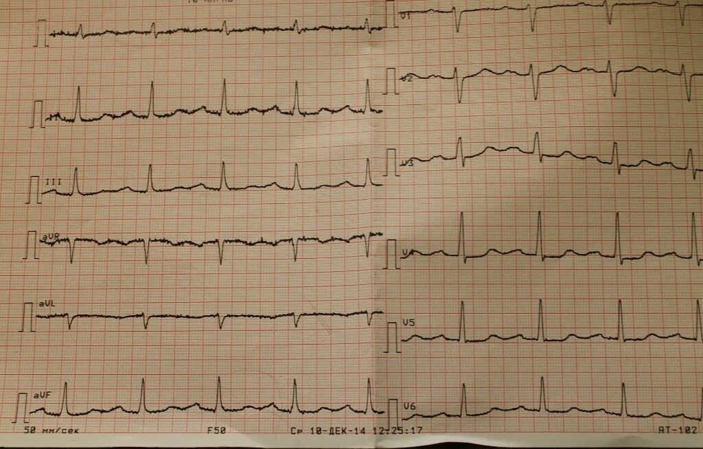 Нормальная лента ЭКГ. ЭКГ пленка норма. ЭКГ пленка норма кардиограммы сердца. Нормальная ЭКГ 50 мм/с. Тяжелое экг