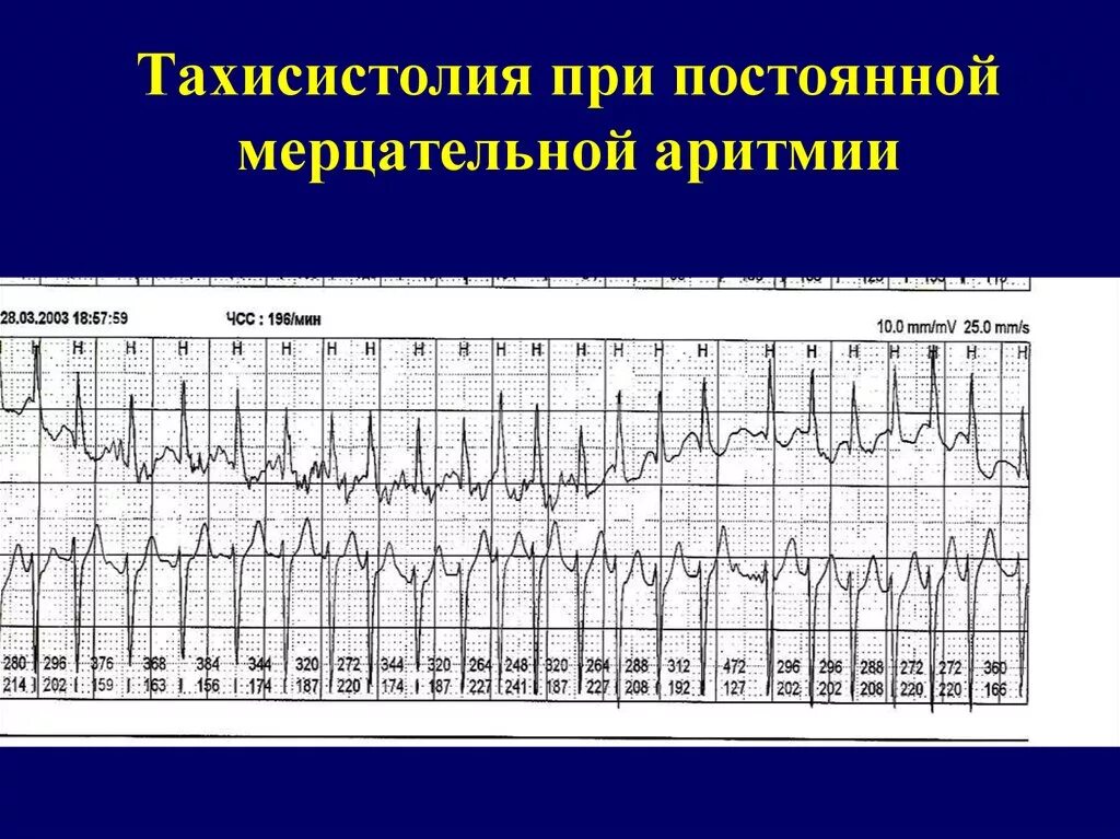 Мерцательная аритмия тахисистолическая форма ЭКГ. Фибрилляция предсердий тахисистолическая форма ЭКГ. Мерцательная аритмия холтеровское мониторирование. Фибрилляция предсердий Мерцательная аритмия ЭКГ.