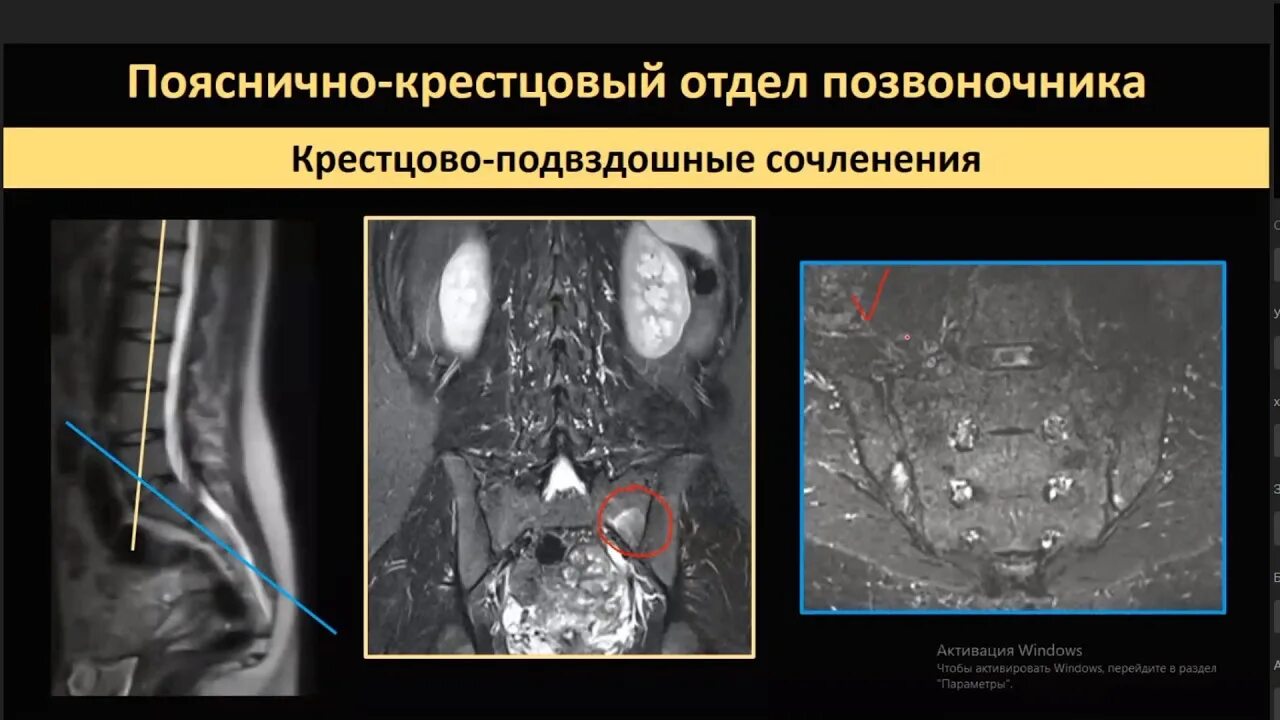 Мрт крестцового отдела позвоночника как подготовиться. Укладки на кт для рентгенолаборантов. укладки мрт для рентгенолаборантов. угол богарта на мрт. роль рентгенолаборанта при проведении мрт.