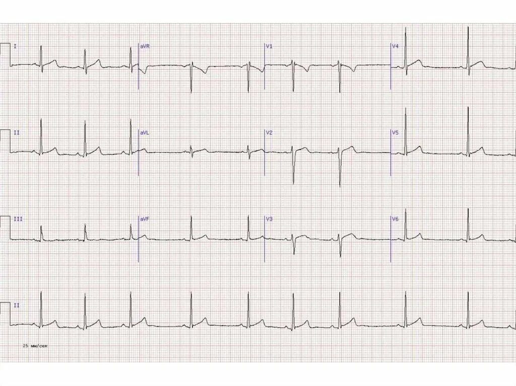 ЭКГ норма. Кардиограмма сердца норма. ЭКГ сердца норма снимок. ЭКГ вариант нормы. Тяжелое экг