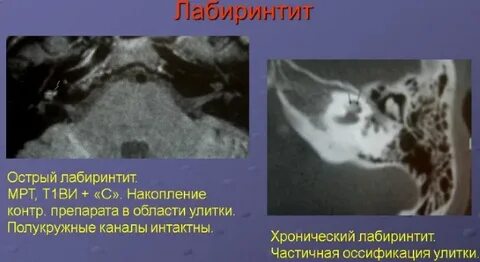 Внутренний отит