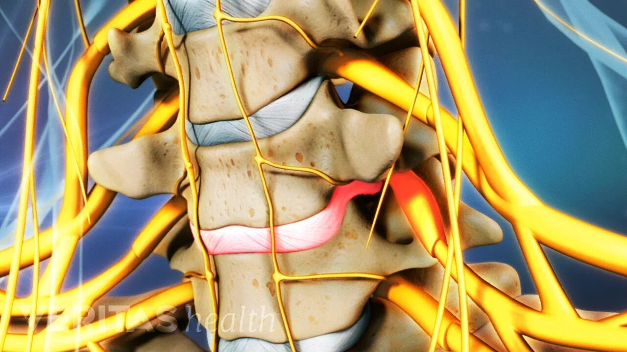 Позвоночник. Двигательный сегмент. Spinal Disc Herniation. Cervical Spinal nerves c6 c7. Остеохондроз с7