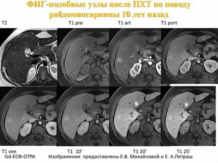 Гиподенсное образование в печени