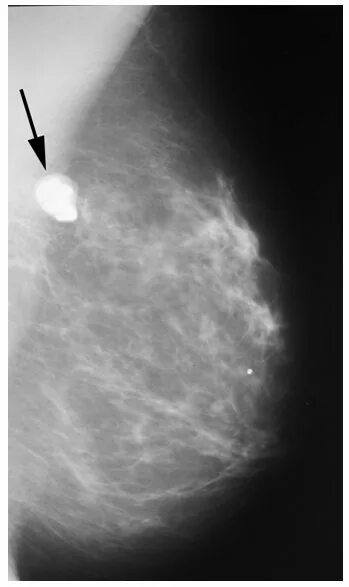 Маммограмма фиброаденома. Фиброаденома молочной железы маммография. Маммография фиброаденома. Фиброаденома молочной железы на маммографии УЗИ. Лимфоузел молочной железы маммография