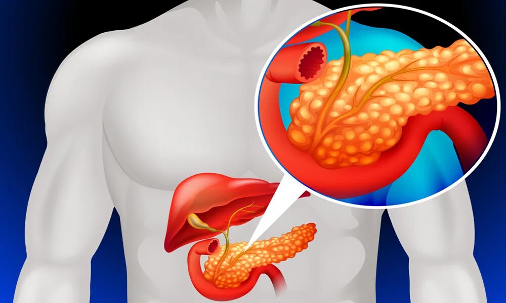 Панкреатит поджелудочной железы. Болезнь поджелудочной железы панкреатит. Хронический панкреатит. Острый билиарный панкреатит. Хронический билиарный панкреатит