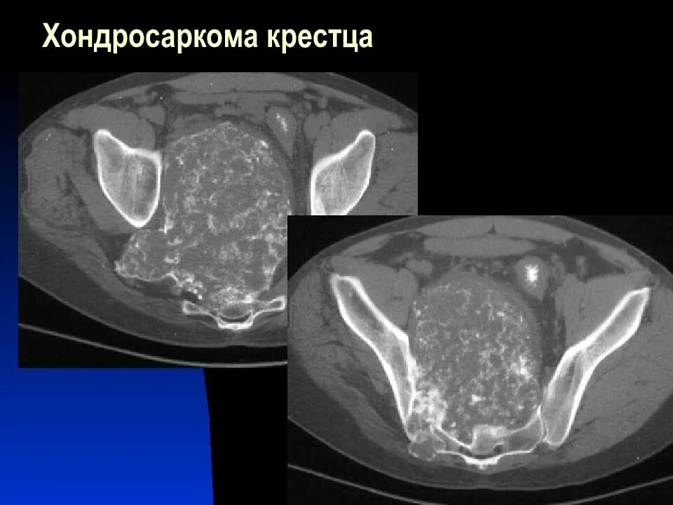 Метастазы в крестце