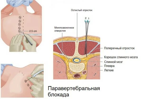 Блокада техника выполнения. Блокада корешковая паравертебральная. Паравертебральная блокада грудного отдела. Паравертебральная блокада поясничного отдела позвоночника. Блокада паравертебральная шейного отдела схема.