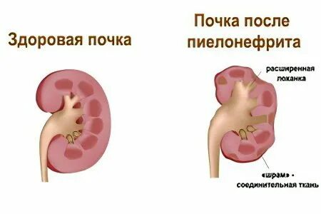 Пиелонефрит живот