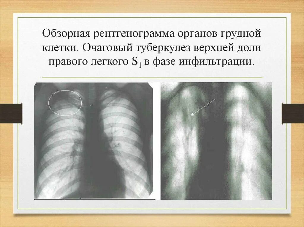 Очаговый туберкулез легких в фазе инфильтрации. Очаговый туберкулез рентген. Очаговый туберкулез верхней доли правого легкого в фазе инфильтрации. Очаговый туберкулез верхней доли правого легкого.