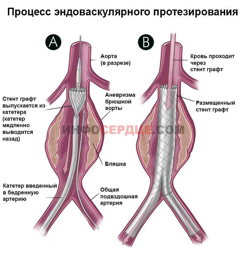 Аневризма брюшной артерии. Эндоваскулярное протезирование аорты. Брюшная артерия аневризм. Аневризма брюшной аорты симптомы.