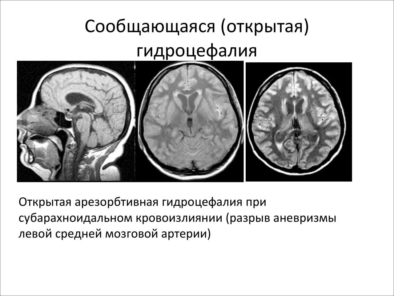 Окклюзионная гидроцефалия мрт. Арезорбтивная гидроцефалия. Наружная гидроцефалия головного мозга кт. Наружная внутренняя гидроцефалия мрт.