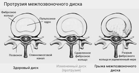Пролабирование диска позвоночника что это