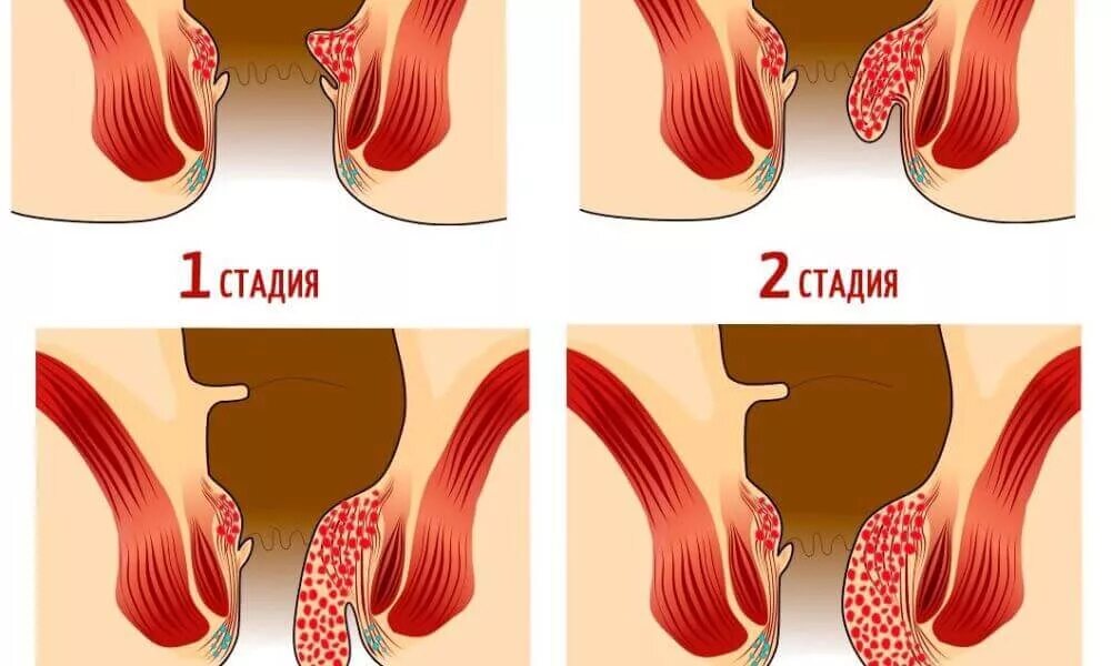 гидроцеле геморрой.