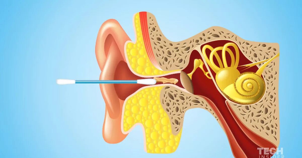 Серная пробка ватные палочки. Чистка ушей ватными палочками. Серная пробка на барабанной перепонке.